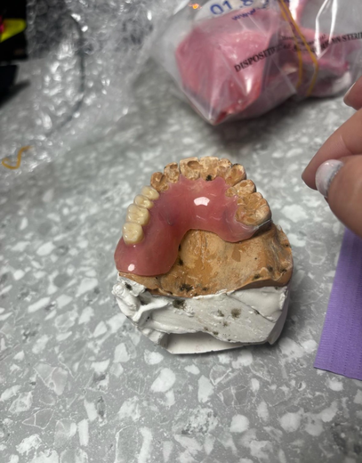 De la moisissure jusque sur les prothèses dentaires...